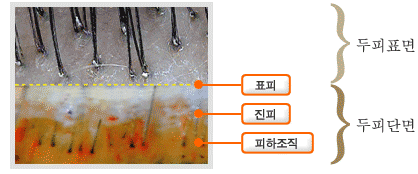 표피,진피,피하조직,두피표면,두피단면